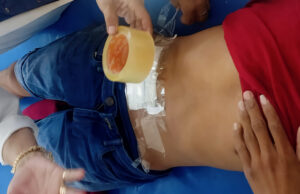 DENUNCIAN QUE USAN DIUREX PARA CURACIONES EN RIBERALTA CON CRISIS DE INSUMOS HOSPITALARIOS